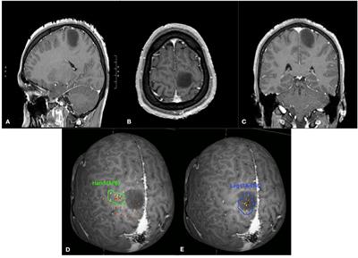 Preoperative Applications of Navigated Transcranial Magnetic Stimulation